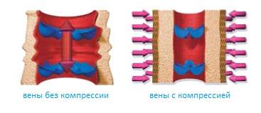 "Компрессионная